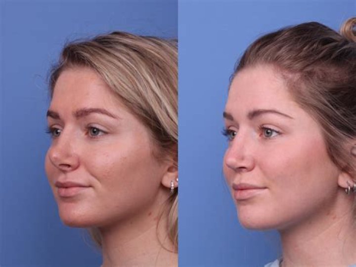 Ashley Leechin Plastic Surgery Before And After: What Is Wrong With Her Face?